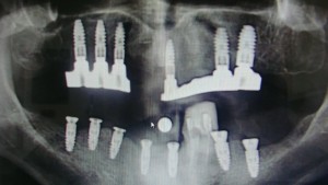 implantologia przyklady implantacji 02