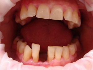 Usunięcie rozchwianego zęba