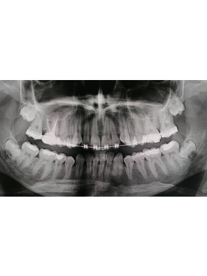 Operacyjne usuwania zębów zatrzymanych z użyciem piezo-surgery